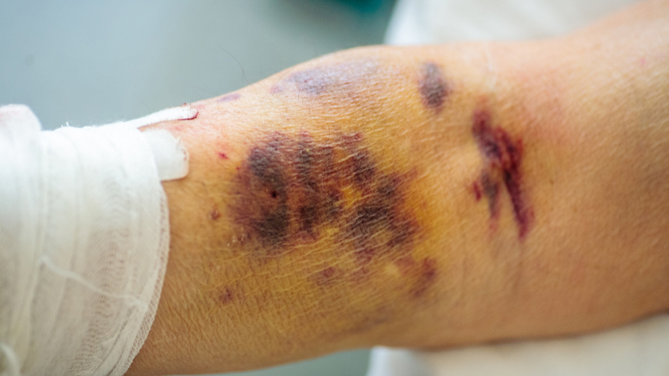 A bandaged arm